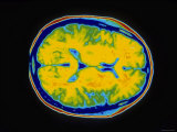 Normal MRI Head Transverse Magnetic Resonance Image Photographie