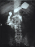 X-Ray Upper GI Study with Barium Photographic Print