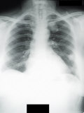 X-Ray Lung Metastatic Sarcoma to Lungs Photographic Print