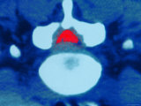 Hernia on Disc in Back Lumbar Cartilage Photographic Print