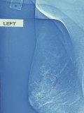Mammogram Breast Cancer Photographic Print
