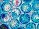 Virology Electron Micrograph Herpes Simplex Viruses Acute Eruption Blisters Fotografie-Druck