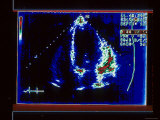 Echocardiogram, Hypertension Photographic Print