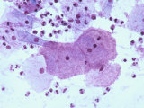 Gardnerella Vaginalis Clue Cells Pap Smear X10 Photographic Print