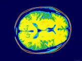 Normal MRI Head Transverse Magnetic Resonance Image Photographic Print