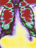Lungs Chest X-Ray Photographic Print