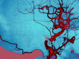 Blocked Vein Brain Burst Aneurysm Cerebral Blood Fotografisk tryk Blocked Vein Brain Burst Aneurysm Cerebral Blood Fotografisk tryk