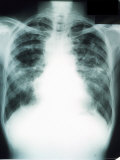 Sarcoid of Lung X-Ray Lung X-Ray Sarcoid Photographic Print
