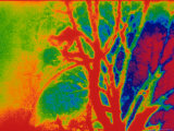Pulmonary Angiogram Abnormal Photographic Print