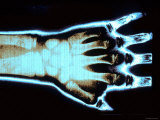 X-Ray Normal Wrist Hand Mouse Keyboard Use Injury Photographic Print