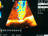 Color Transesophageal Echo Mitral Regurgitation Photographic Print