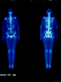 Technetium 99 Nuclear Med Bone Scan Whole Body Photographic Print