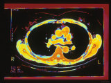 CT Scan, Chest Inc.Heart 66 Year Old Woman Photographic Print