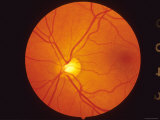 Normal Retina View Thru Fundus Photographie