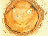 Photomicrograph Occluded Coronary Artery Show Plaque Build Up Photographic Print