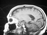 Brain Tumor in MRI Cancer Medical Imaging Photographic Print