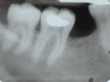 X-Ray of Wisdom Tooth and Molars in Mouth Photographic Print