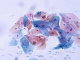 Pap Smear Mild Dysplasia Photographic Print