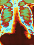 Chest X-Ray, Pneumonia Photographic Print