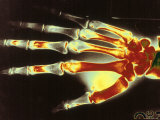 Digitized X-Ray of Normal Human Hand Fotografie-Druck