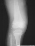 X-Ray Left Knee Joint Lateral View Photographic Print