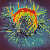 Breast Cancer Cell Gynecology Research Fotografie-Druck