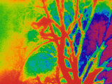 Pulmonary Angiogram Abnormal Photographic Print