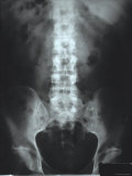 X-Ray Ls Spine and Normal Bowel Gas Pattern Photographic Print