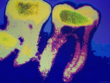 X-Ray of Two Teeth in Jaw in Color Lámina fotográfica