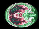 Magnetic Resonance Imaging Head at Level of Orbits Photographic Print
