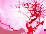 Aneurysm Brain Vessels Cerebral Blood Burst Vein Photographie
