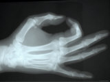 X-Ray Normal Hand Pinch Study Photographic Print