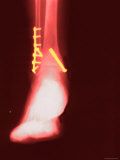 Bone Brace Xray Enhanced Red Surgically Implanted Photographic Print