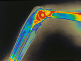 Digitized X-Ray of Normal Human Elbow Photographic Print