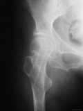 Human Female Hip Joint X-Ray, Osteoporosis Photographic Print