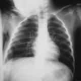Normal Chest X Ray 3 Year Old Child Photographic Print