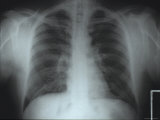 Chest X-Ray Atelectasis Vs. Lung Infiltrate Photographic Print