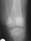 X Ray Normal Knee Joint 7 Year Old Girl Photographic Print