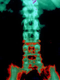 X-Ray Depicting Back Pain Spine and Pelvis X-Ray Fotografie-Druck
