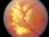 Fundus Clinical Os Serpinginous Choroiditis Photographic Print