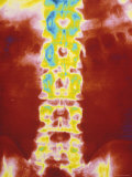 Digitized Radiograph Pelvis Spine X-Ray Lámina fotográfica