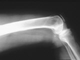 X-Ray Normal Human Knee Joint Photographic Print