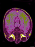 Brain Hemispheres Visible Colorized MRI Normal Photographic Print