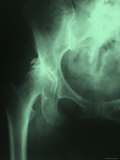 Xray of Hip Femur Joint Pelvis Leg Abdomen Colored Photographic Print