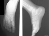 X-Ray Normal Ankle and Foot Dorsal Lateral Foot Ankle Photographic Print