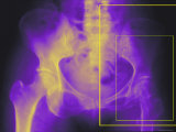 Xray Colorized Female Hip Pelvis Osteoporosis Photographic Print