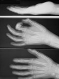 X-Ray Normal Hand Wrist Pinch Dorsal Lateral View Photographic Print