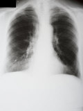 Chest X-Ray Post Operative Mastectomy Photographic Print