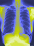 Normal Chest X-Ray with Spine and Ribs Fotografie-Druck