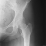 X-Ray Normal Pelvis Acetabulum Head of Femur Photographic Print